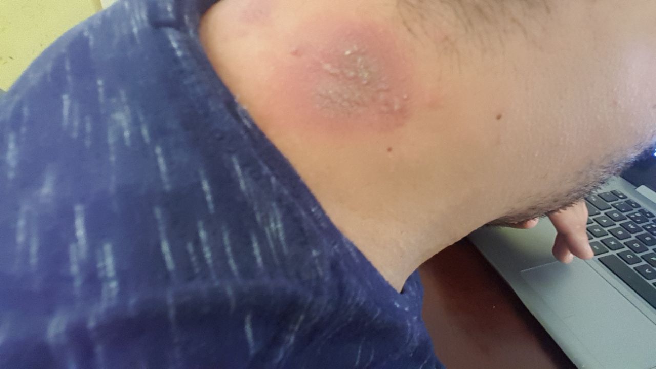 Lesão causada por potó na região do pescoço
